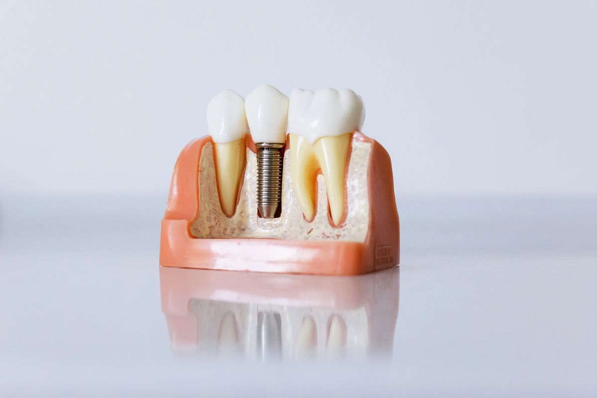 Stomatološke usluge - Dental Point - Oralna kirurgijai implantologija