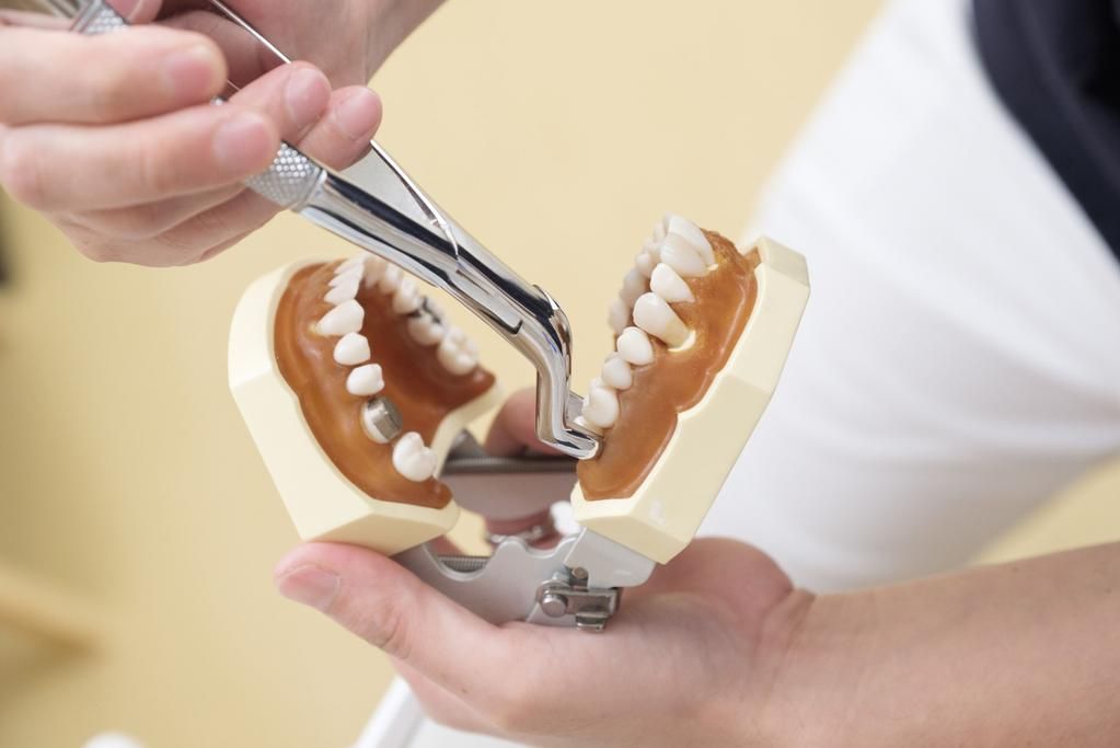 Oralna kirurgija i implantologija - vađenje zuba